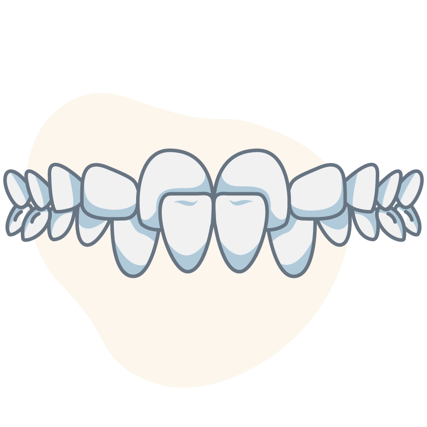 crossbite-front-teeth-side
