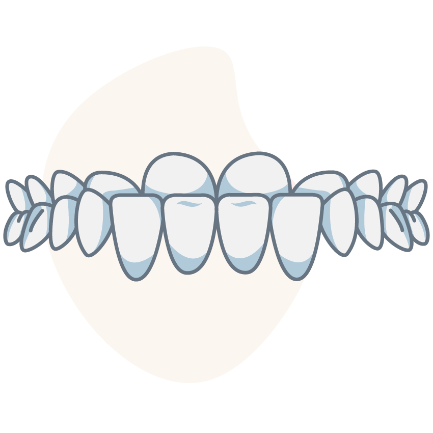 underbite-side
