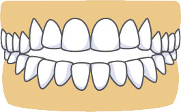 Open-Bite