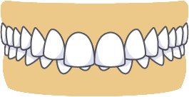 Overbite
