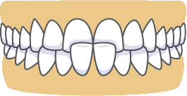 crossbite-front